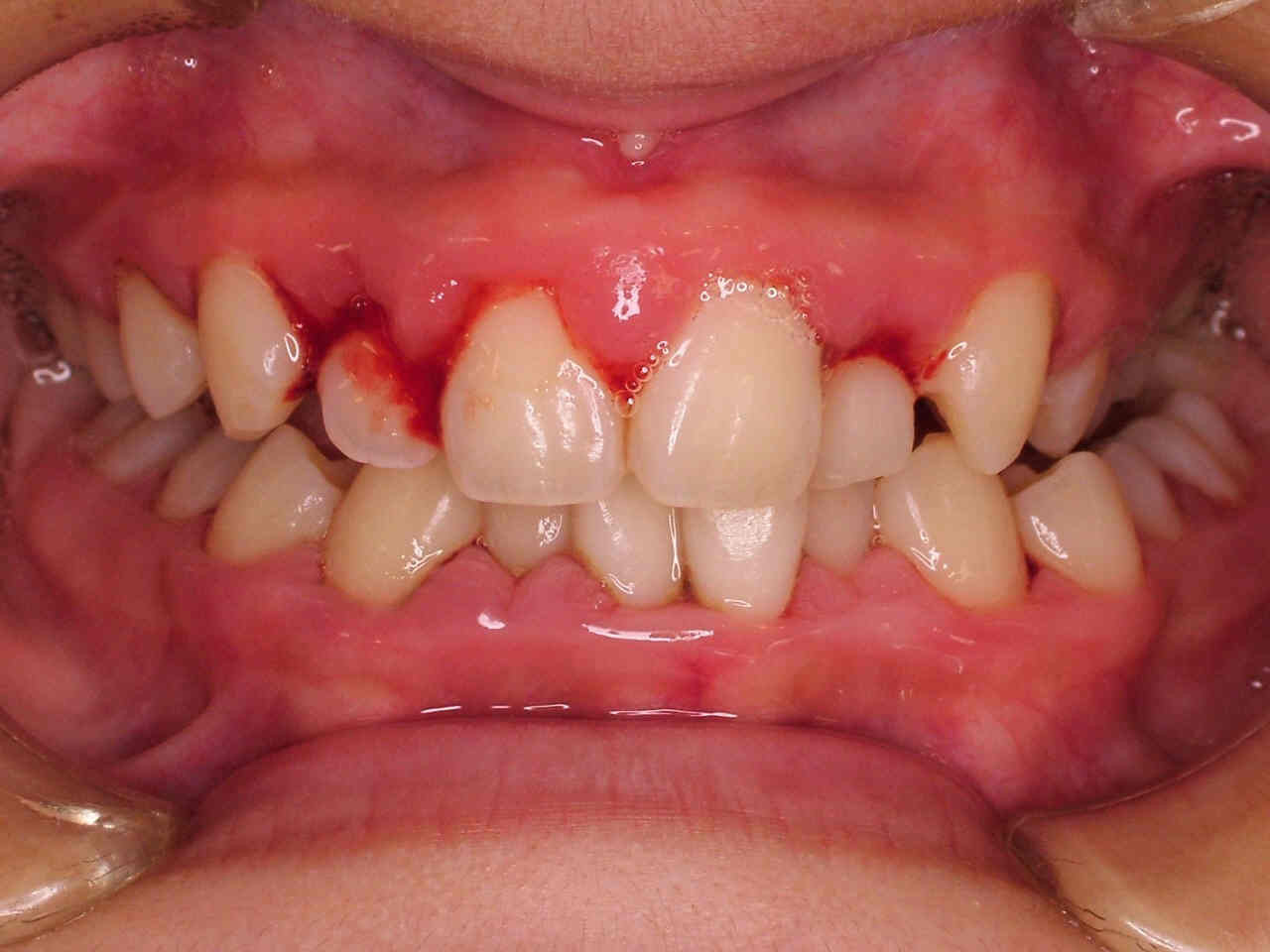 の 歯茎 出し 方 腫れ 膿 の