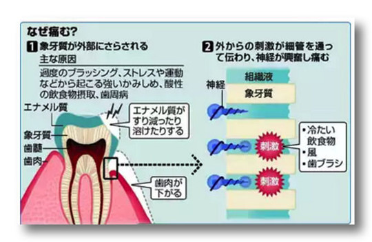 治す 知覚 過敏